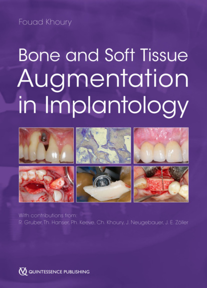 Bone and Soft Tissue Augmentation in Implantology - Группа авторов